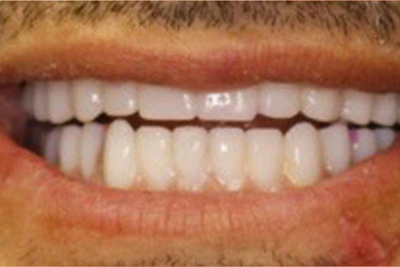 allon4_implant_after