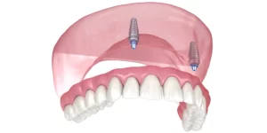 What is Denture stabilization?