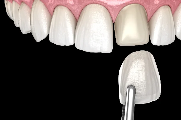 What Are Porcelain Veneers
